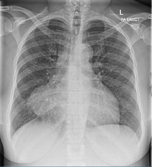 CXR was performed on admission which is shown below